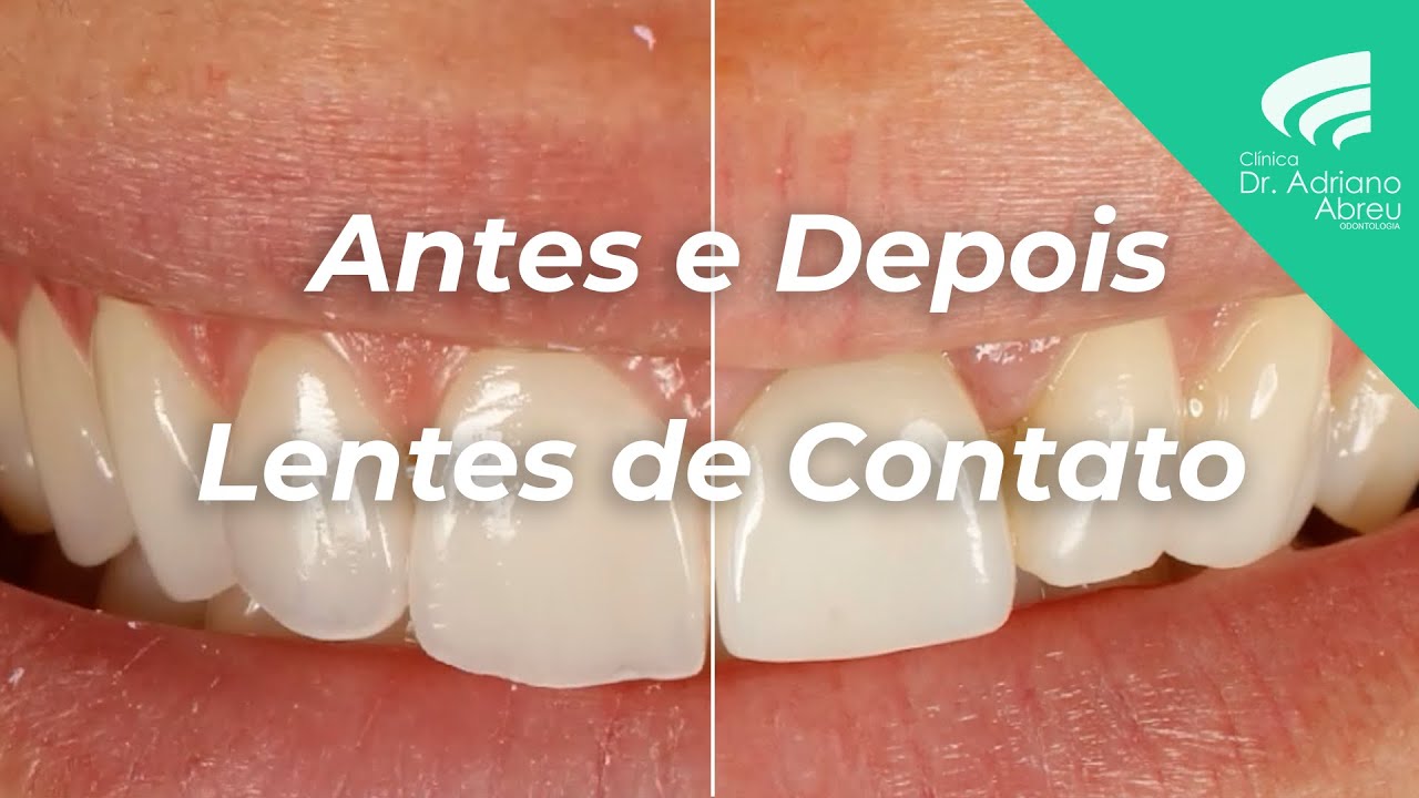 Antes e Depois Lentes de Contato Dental