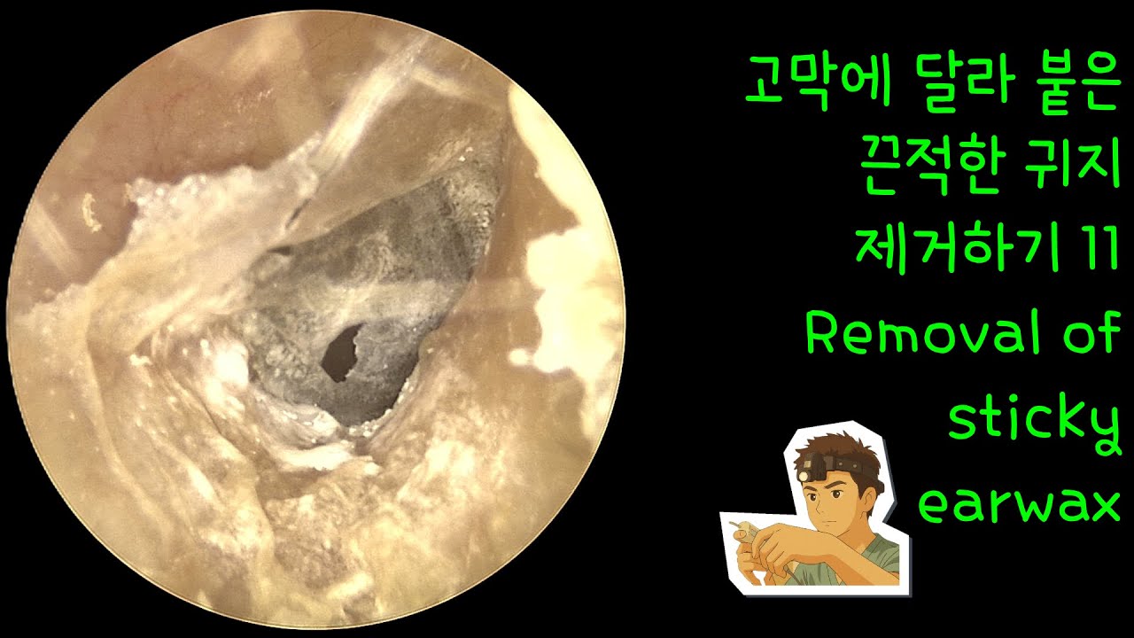 고막에 달라 붙은 끈적한 귀지 제거하기 11 (Removal of sticky earwax)