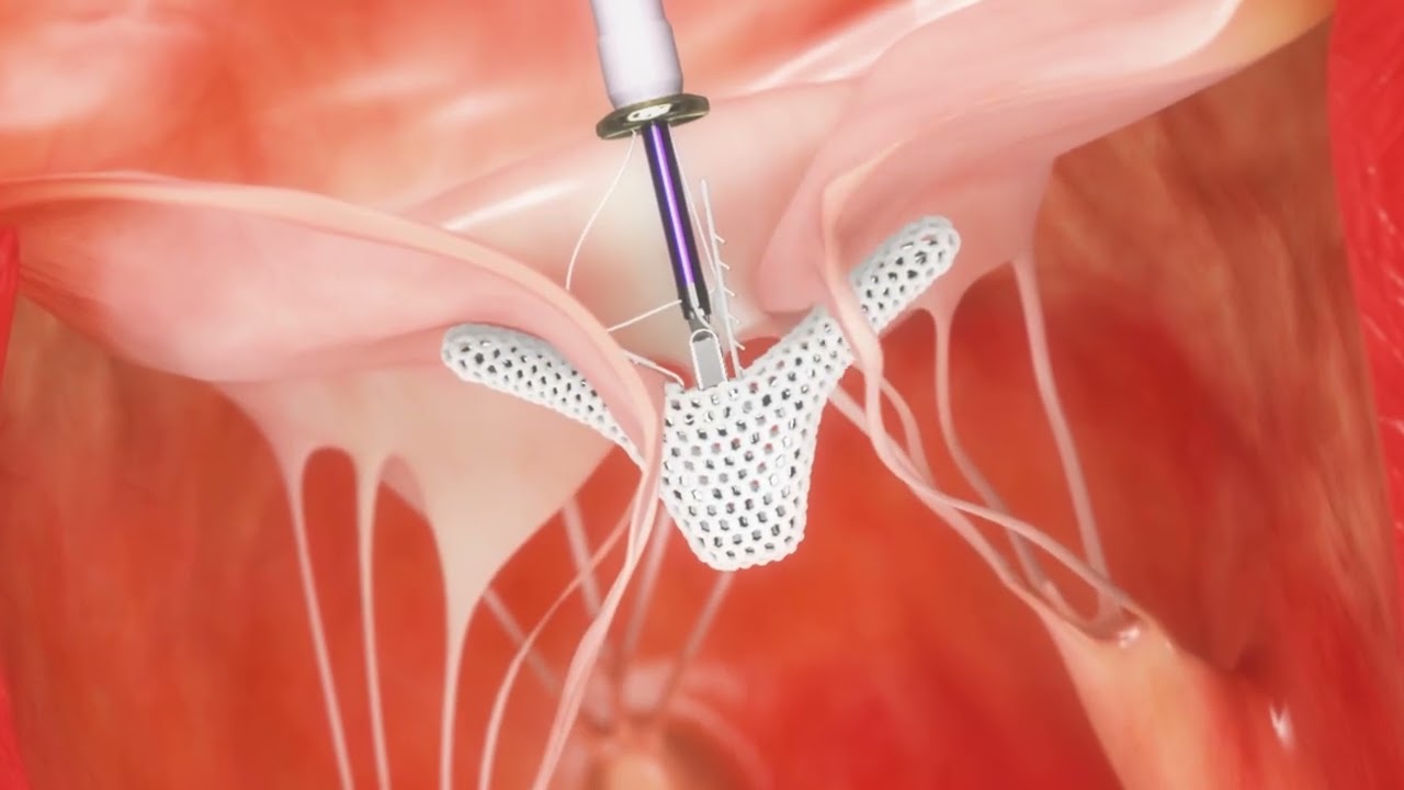 Triclip™ Transcatheter Tricuspid Valve Repair System