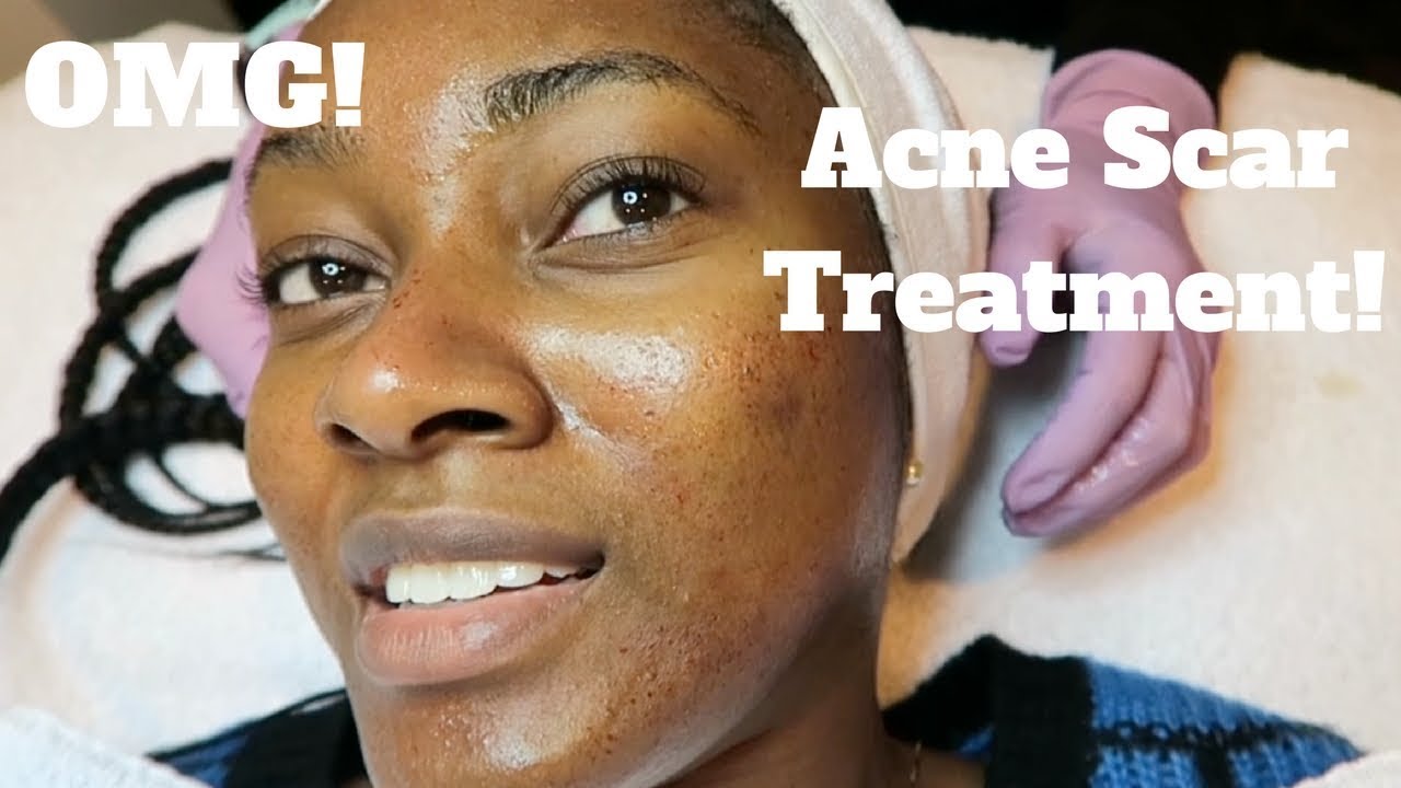 My Dermatology Acne Scar Treatment! | Microneedling Experience