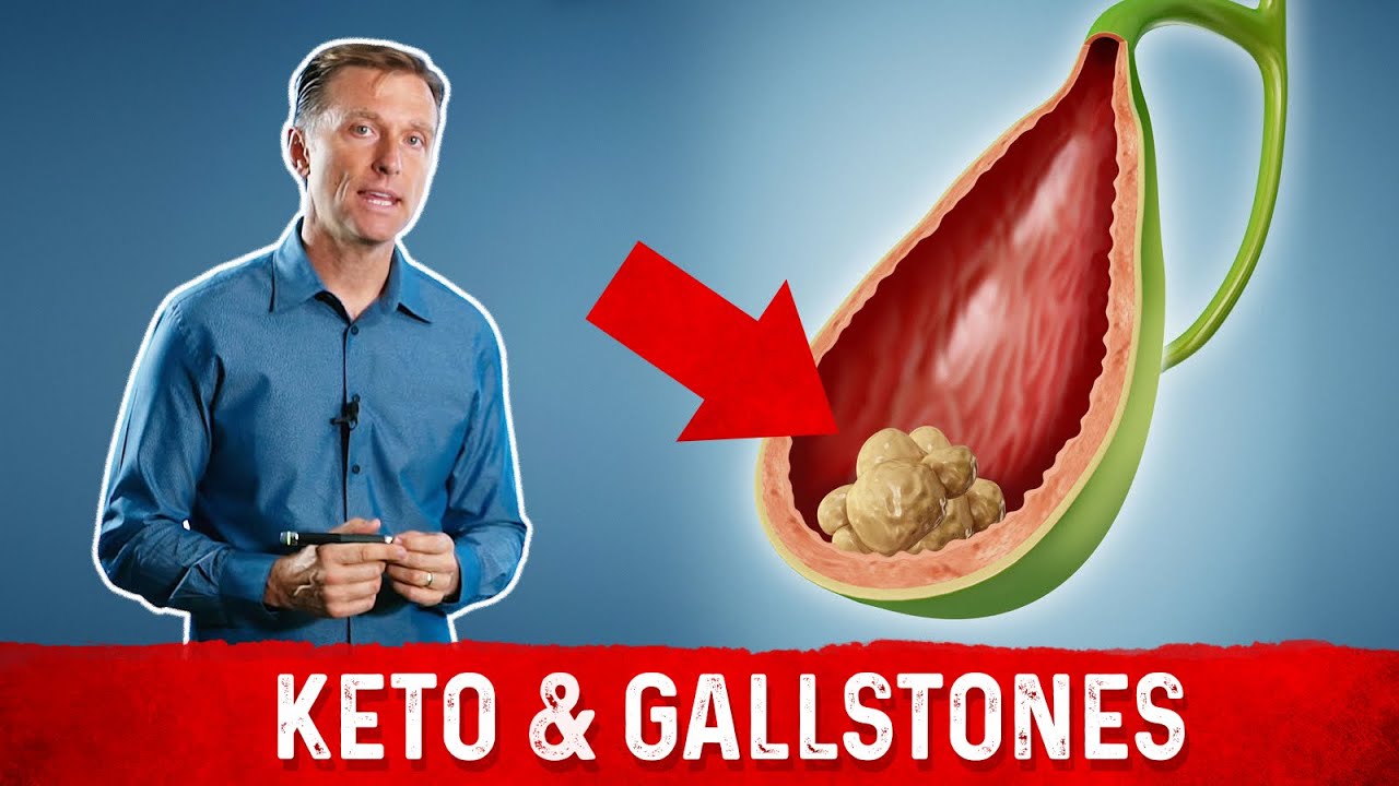 Doesn't Keto Cause Gallstones Eating All That Fat?