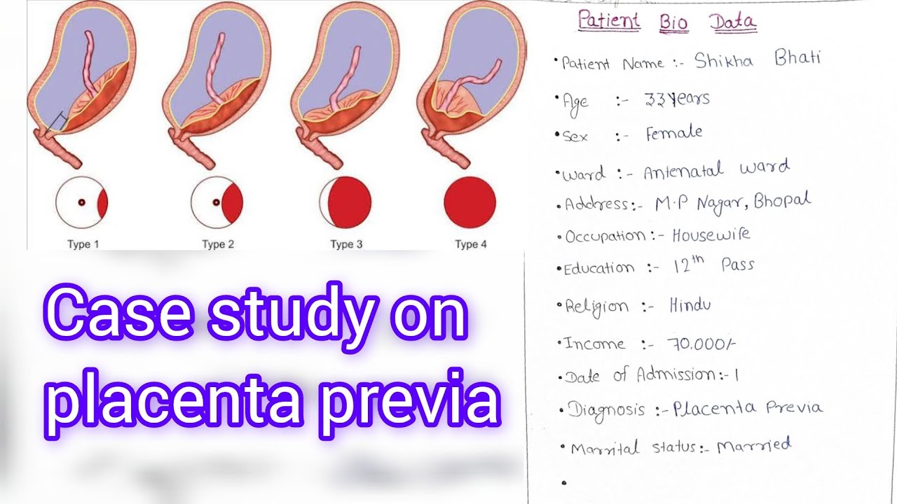 case study on placenta previa 