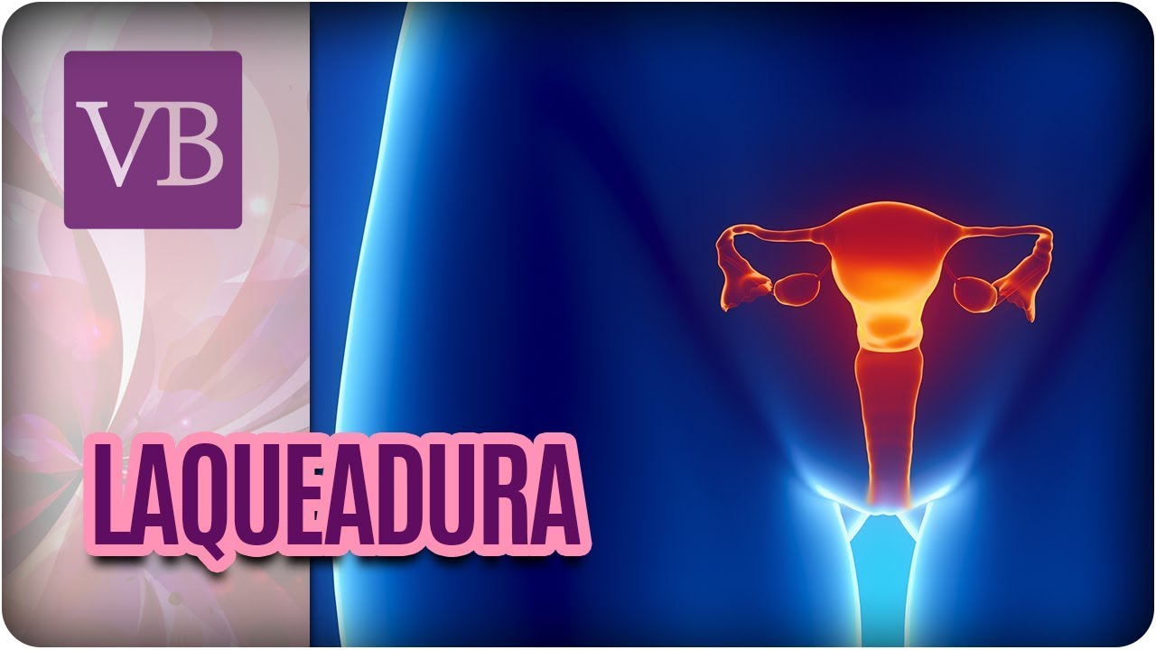 Laqueadura: Cirurgia e Reversão - Você Bonita (30/01/18)