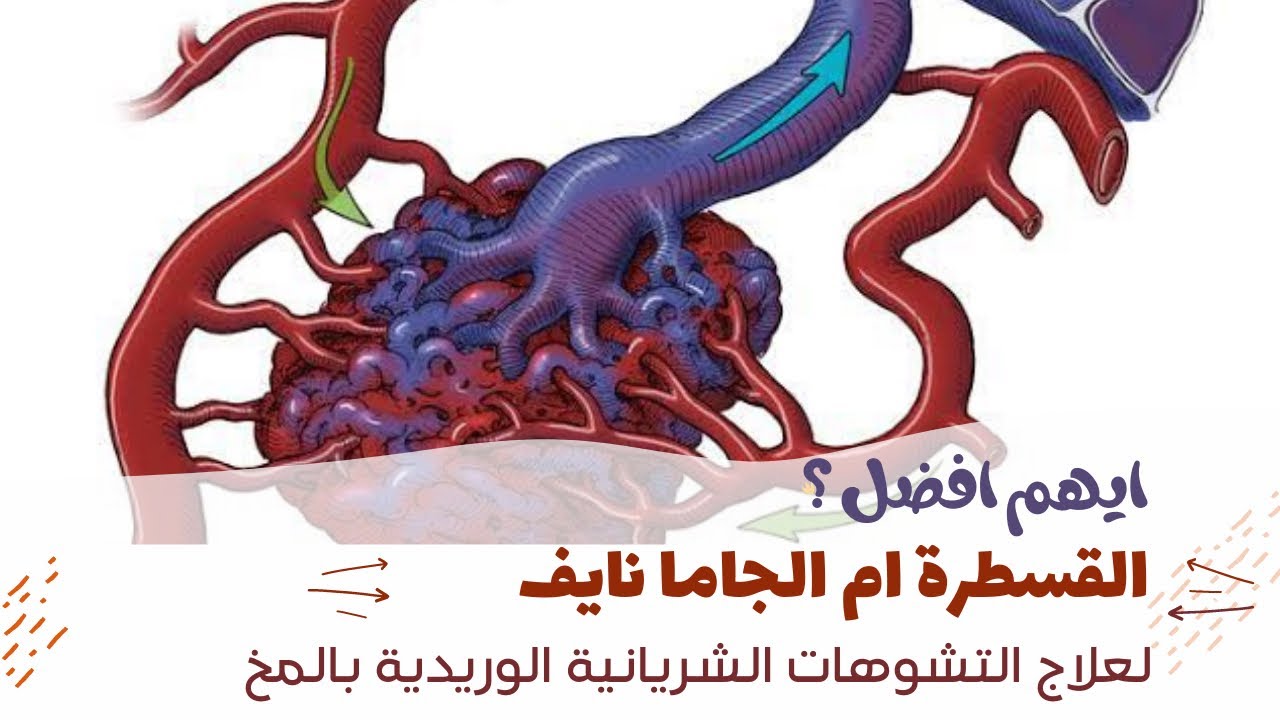 ايهم افضل ؟ قسطرة الدماغ ام الجاما نايف لعلاج التشوهات الشريانية الوريدية بالمخ