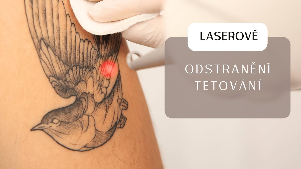 Nejbezpečnější laserové odstranění tetování.