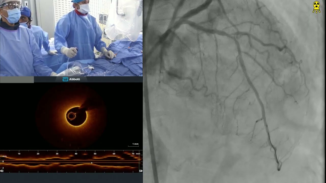 Staged PCI of Calcified LAD-D1 Bifurcation using IVL + Rota with OCT Imaging