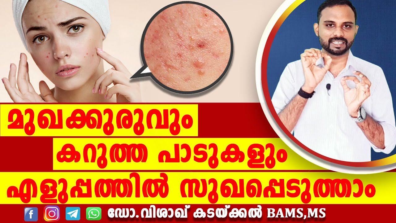 Pimples [Acne] treatment malayalam health tips | മുഖക്കുരു എളുപ്പത്തിൽ സുഖപ്പെടുത്താം |
