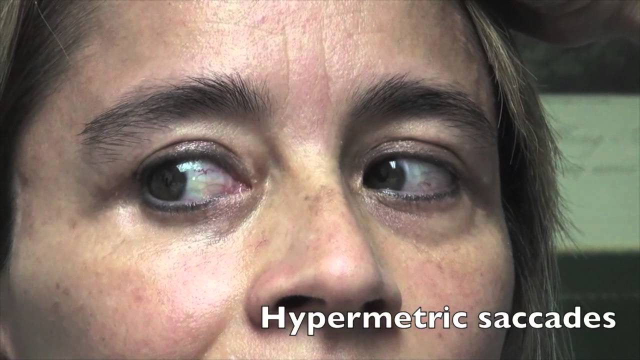 Case Challenge: The patient had hypermetric saccades. (Video 1)