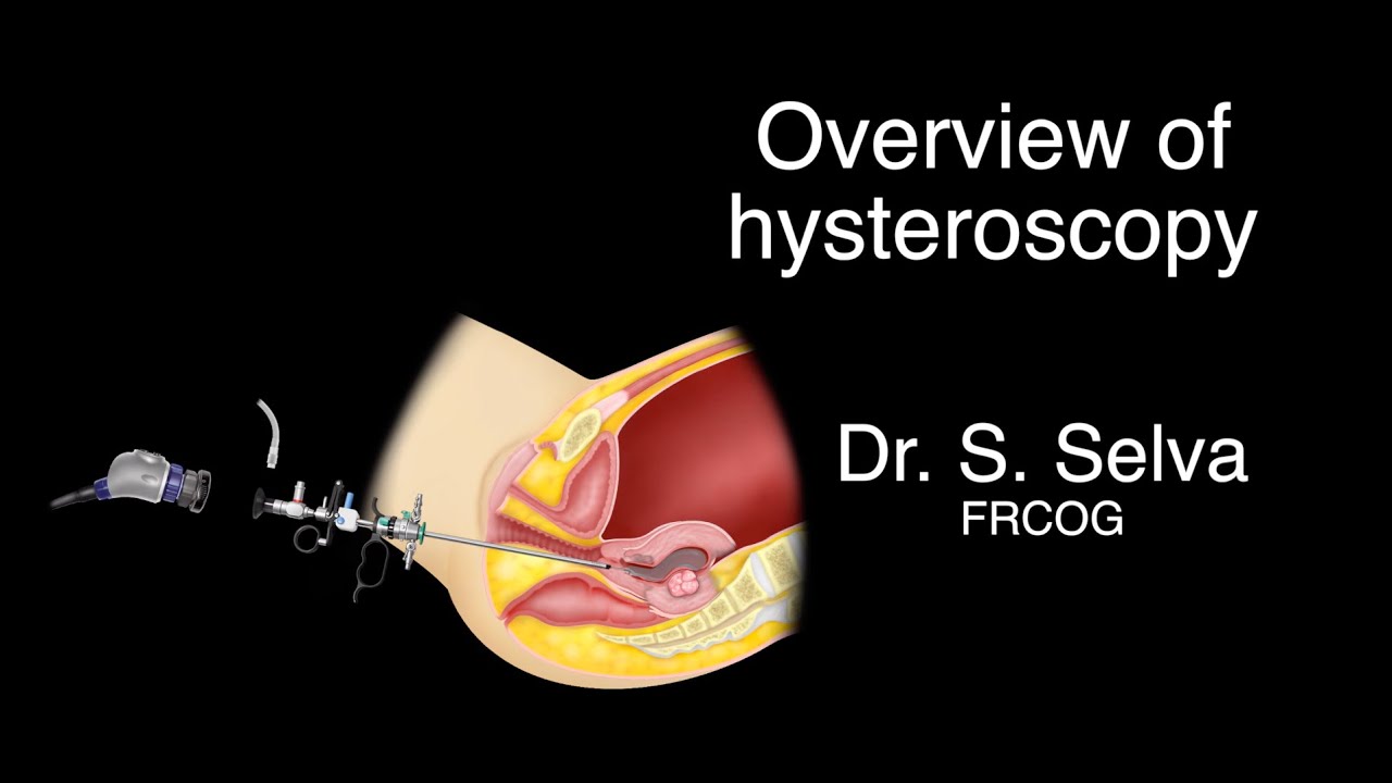 Video 36 1 Overview of hysteroscopy