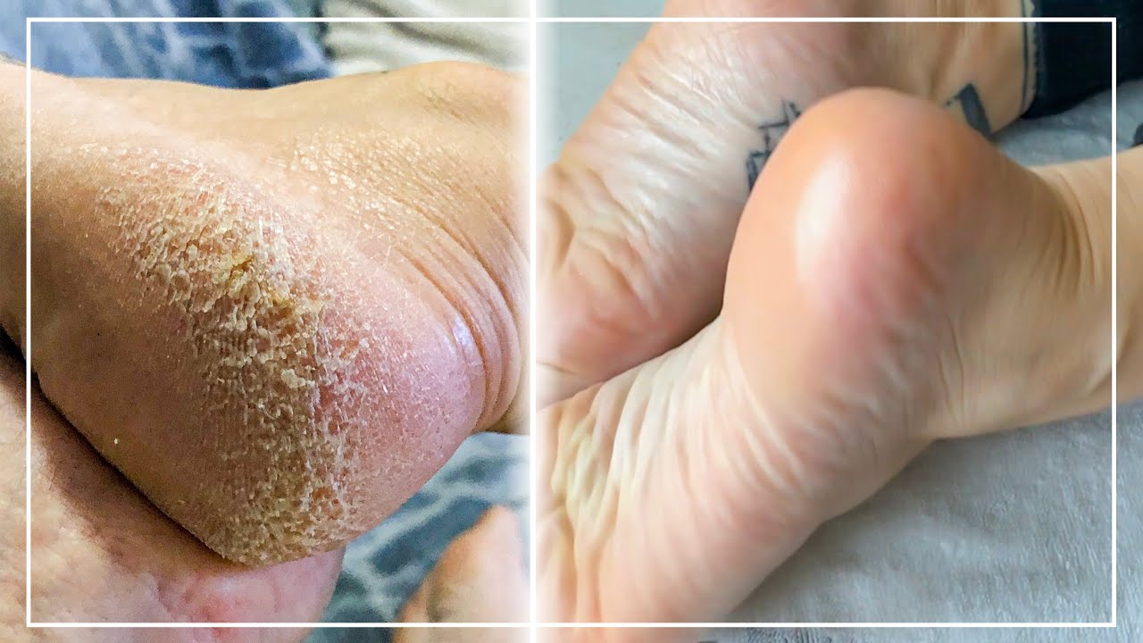 TRANSFORMER DES PIEDS TRÈS SECS EN PIEDS DE BÉBÉ