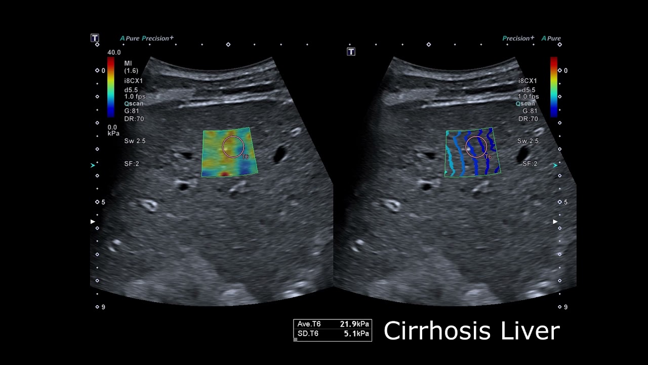 2 SWE Liver Fibrosis _ Zwłóknienie wątroby Elastografia fali poprzecznej _ Canon Medical Systems