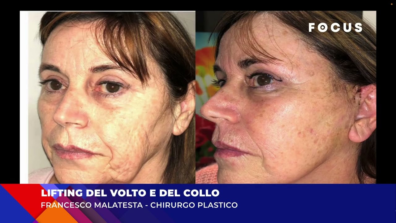 Lifting del Volto e del Collo
