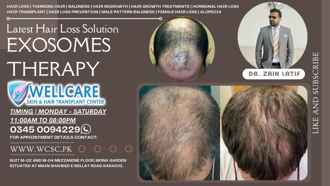 Latest Hair Loss Solution Exosome therapy | Hair Regrowth Treatment in Karachi (in Hindi)