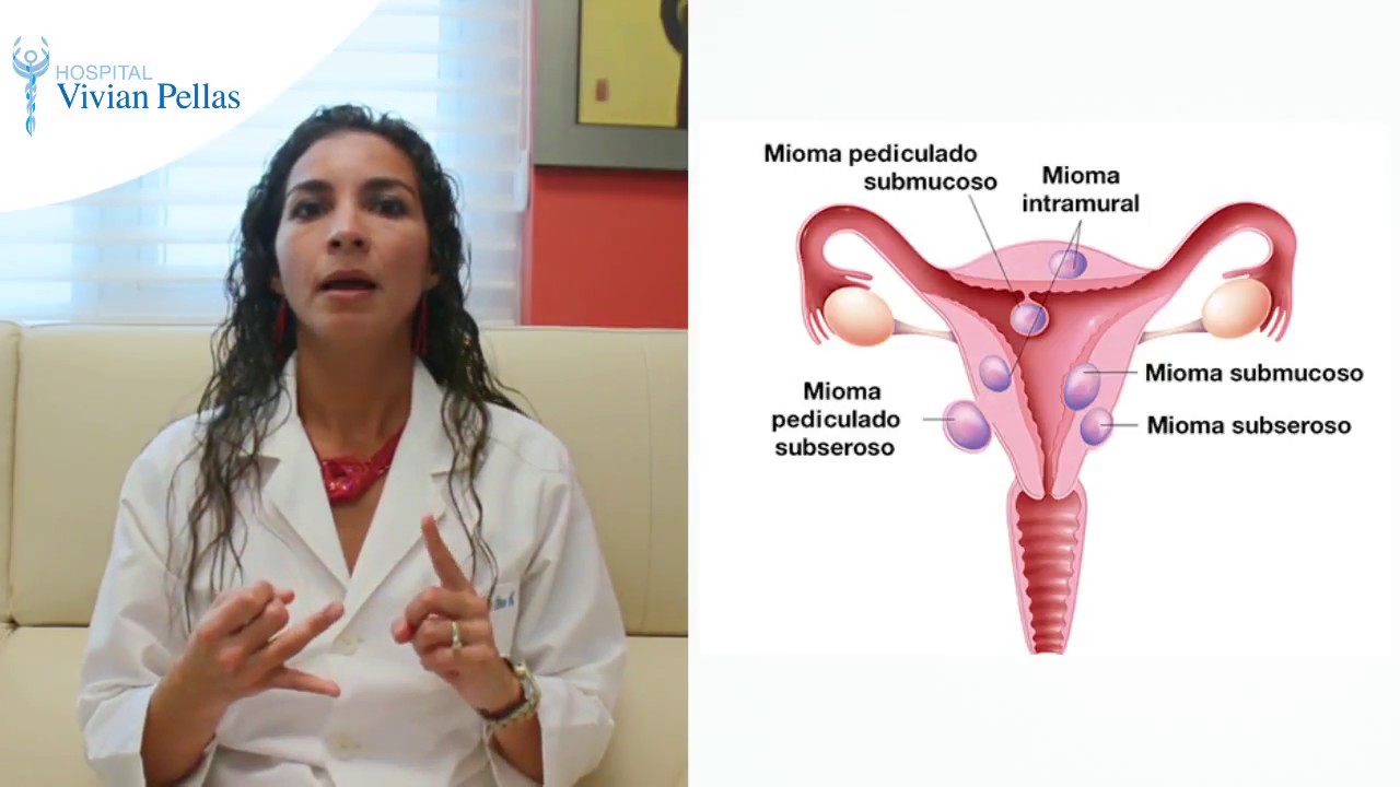 Miomas Uterinos | Dra  María Delma Otero | Hospital Vivian Pellas