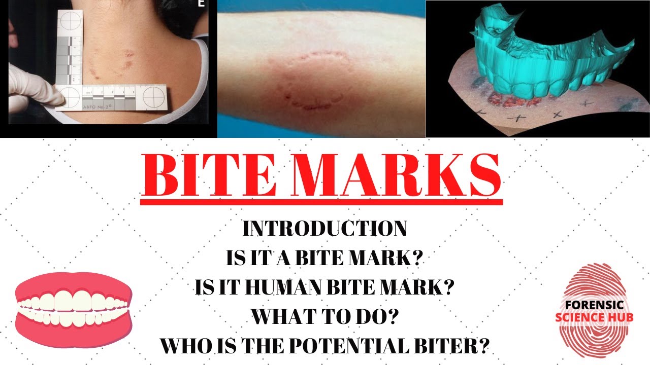 Bite marks | Forensic odontology | UGC NET Forensic science