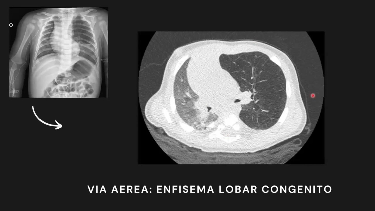 Tórax Hiperlucente por Tomografía