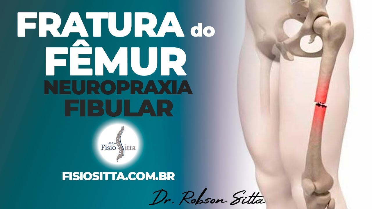 NEUROPRAXIA FIBULAR + FRATURA DIAFISARIA FEMUR + FISIOTERAPIA POS OPERATORIO HASTE Dr. Robson Sitta