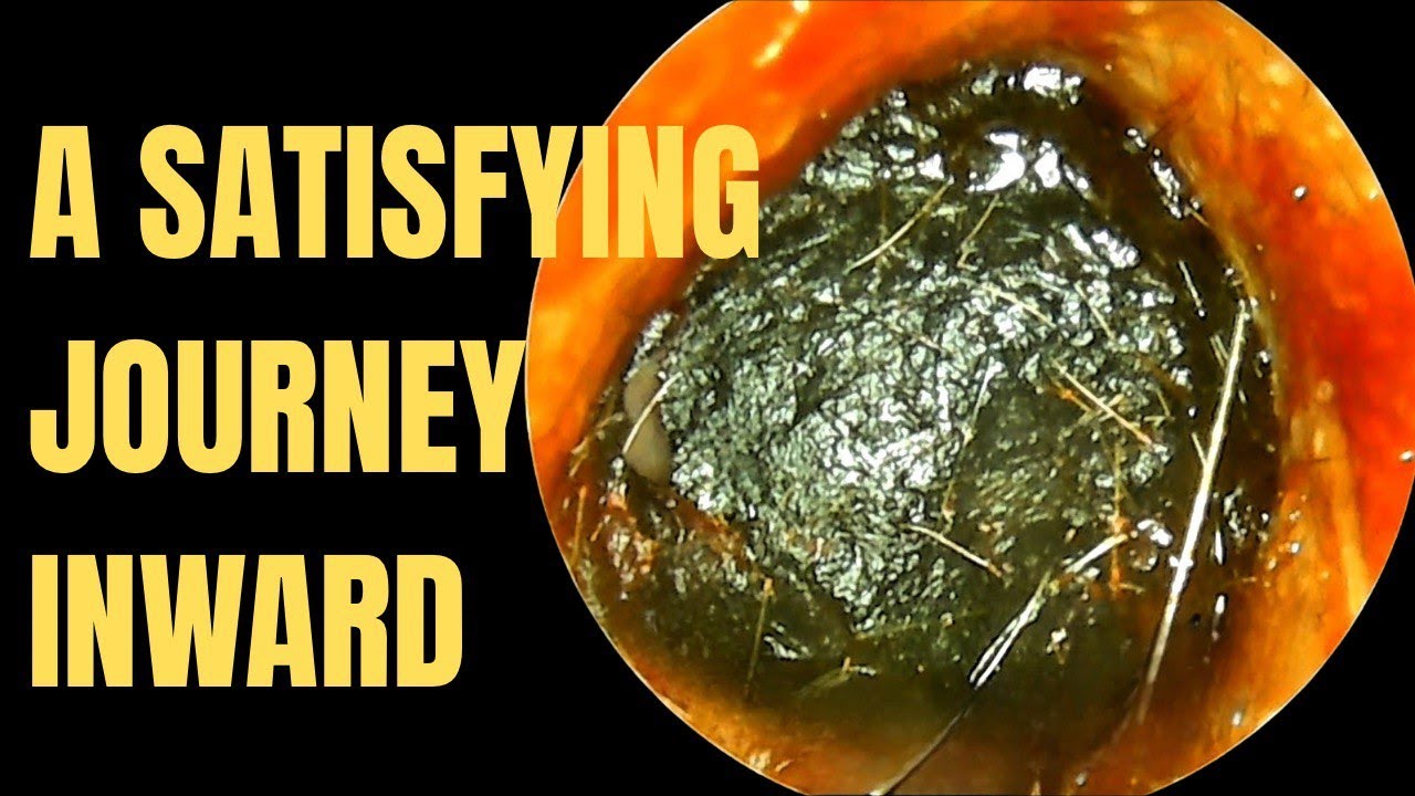 Earwax Uncovered: A Satisfying Journey Inward 