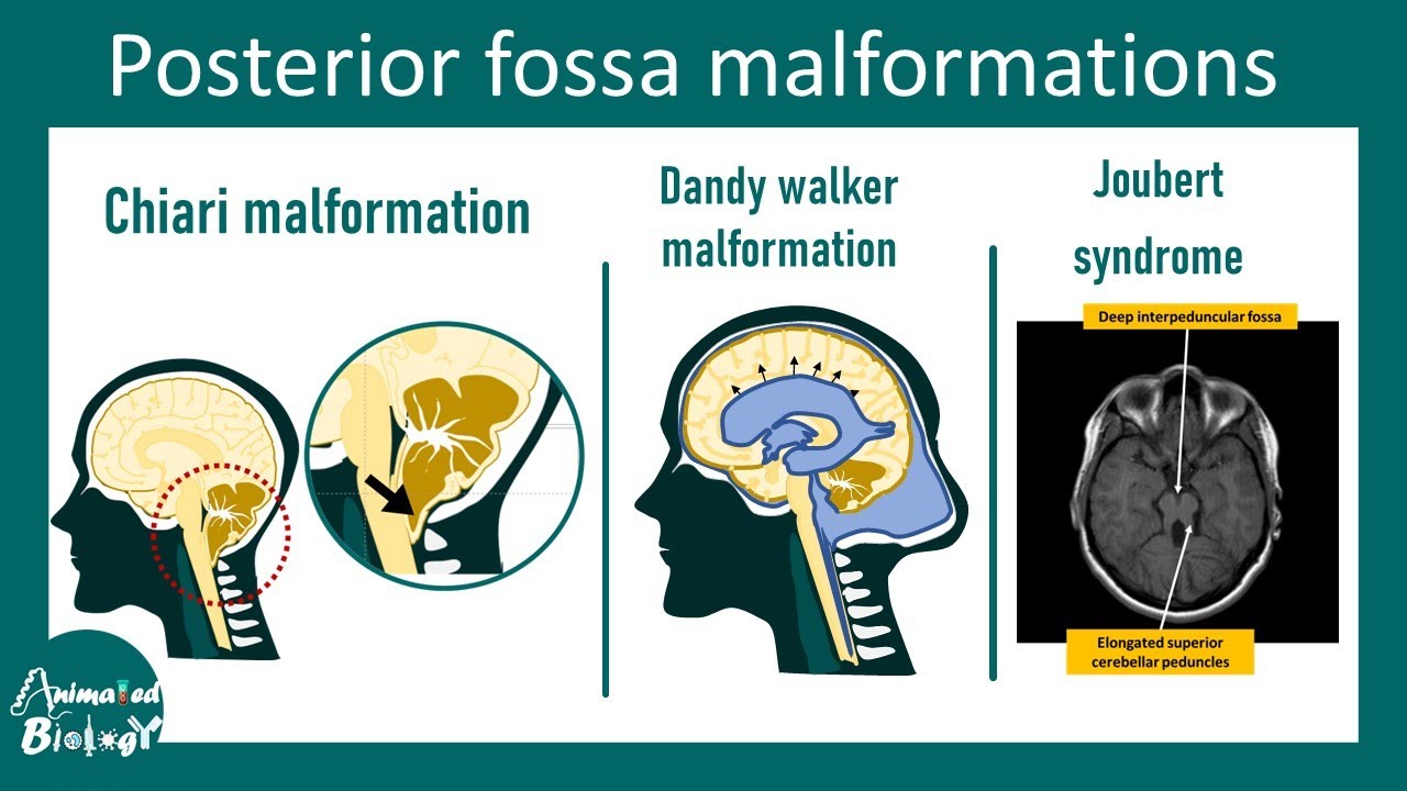 Posterior Fossa malformations | Neurology and Radiology of Posterior Fossa malformations