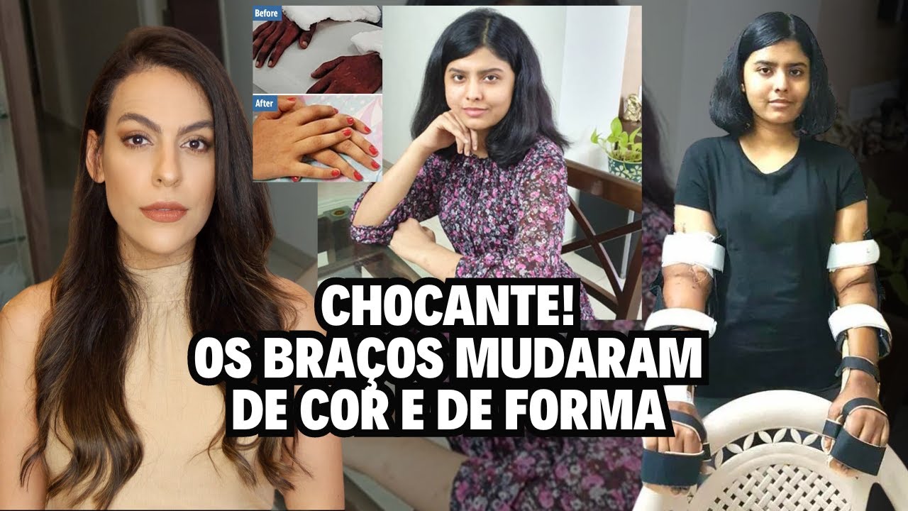Transplantaram braços masculinos nela, e o que aconteceu chocou os médicos!