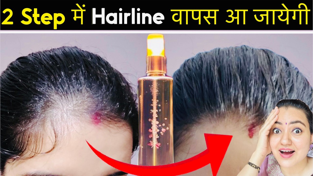2-Step Hairline Regrowth Challenge : Grow Receding Hairline, Bald Patches & Long Thick Hair 100%❤️