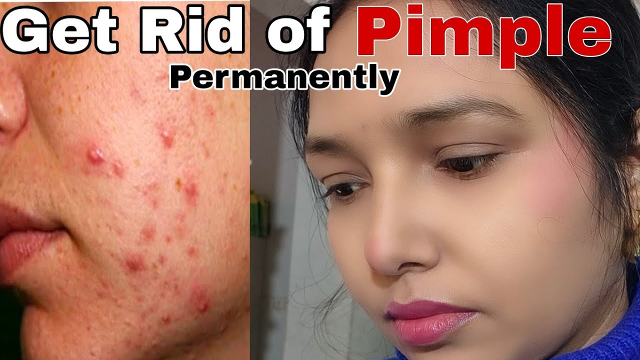 How to Get Rid of Pimples Permanently in 7 Days, #skincare #pimples #acnetreatment 