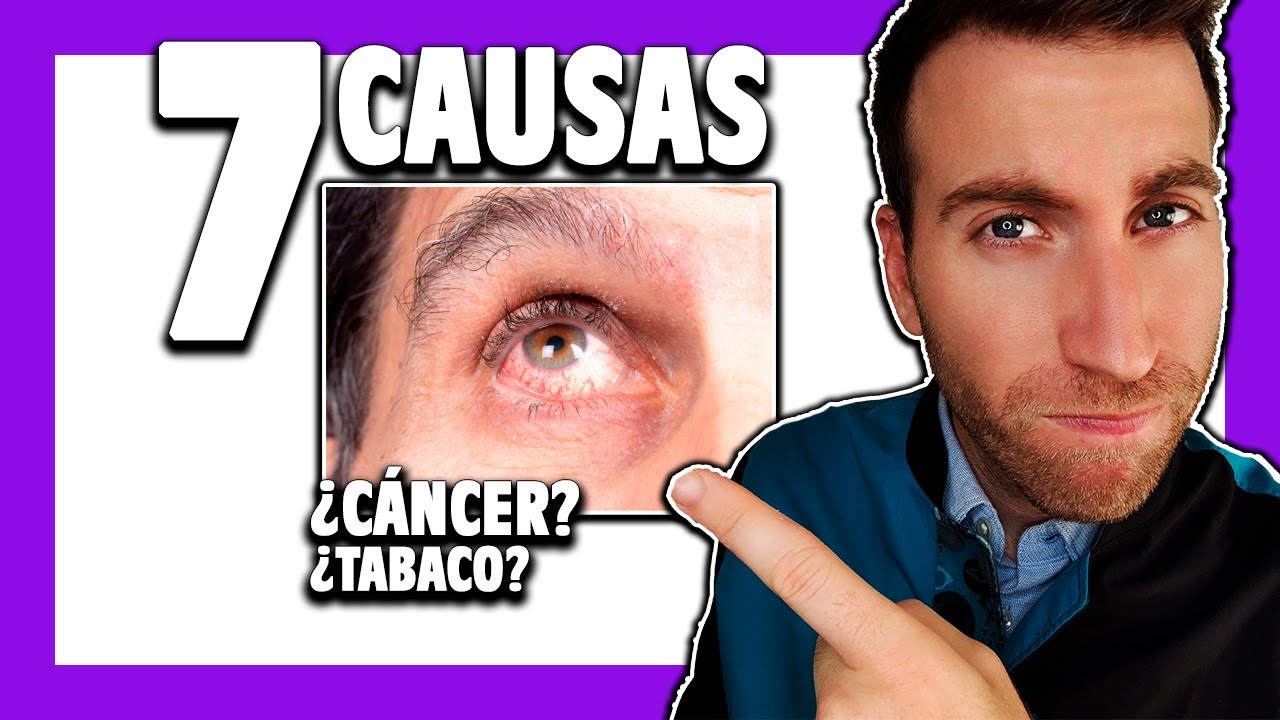 🟪 ¿Qué es la UVEÍTIS ocular? Causas y consecuencias [Cap. 1]