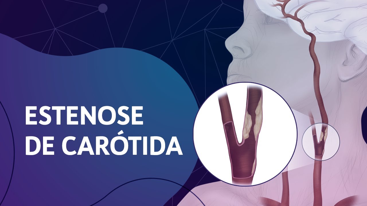 Estenose de Car&oacute;tida