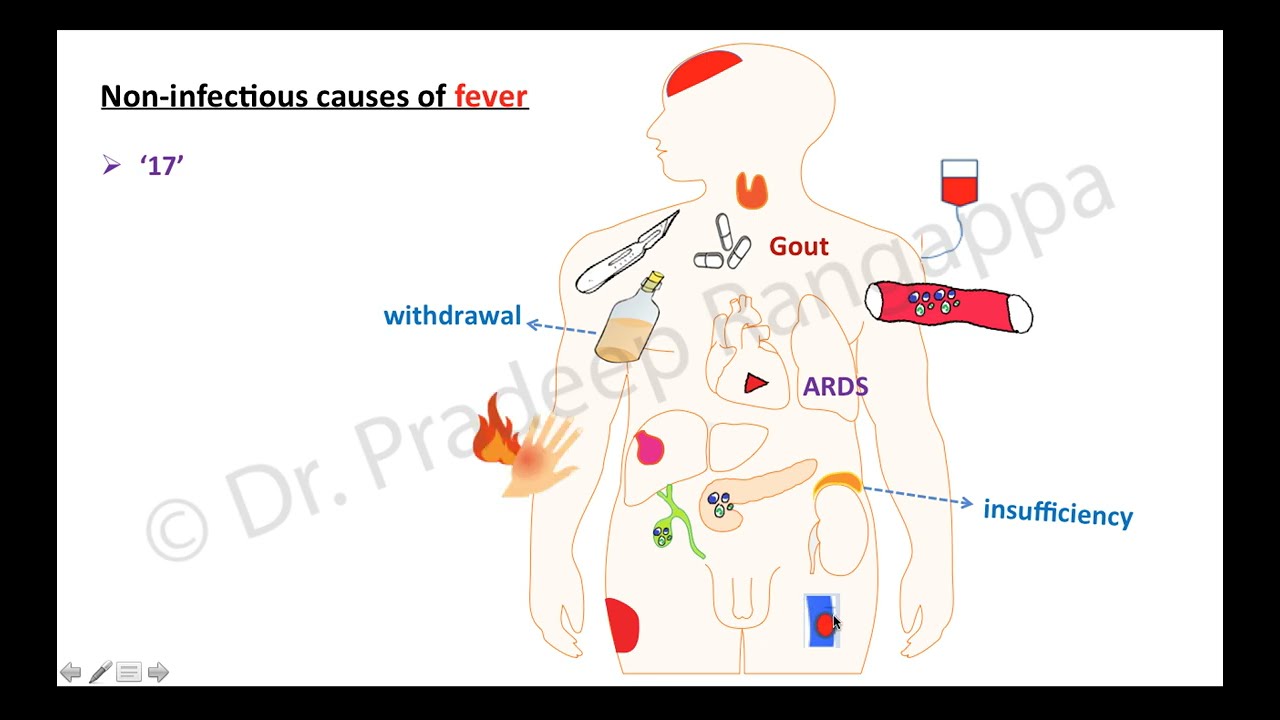 Неинфекционные причины лихорадки в отделении интенсивной терапии | Доктор Прадип Рангаппа