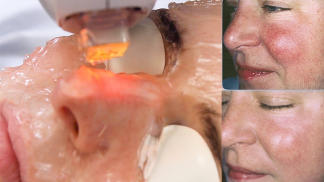 How to get rid of Redness on the Face? Treat Rosacea with LASER + DIET