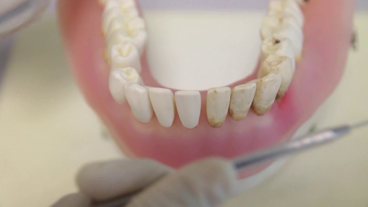 [Periodontal Examination Series] 11. Tooth Mobility (Miller Classification 1950)