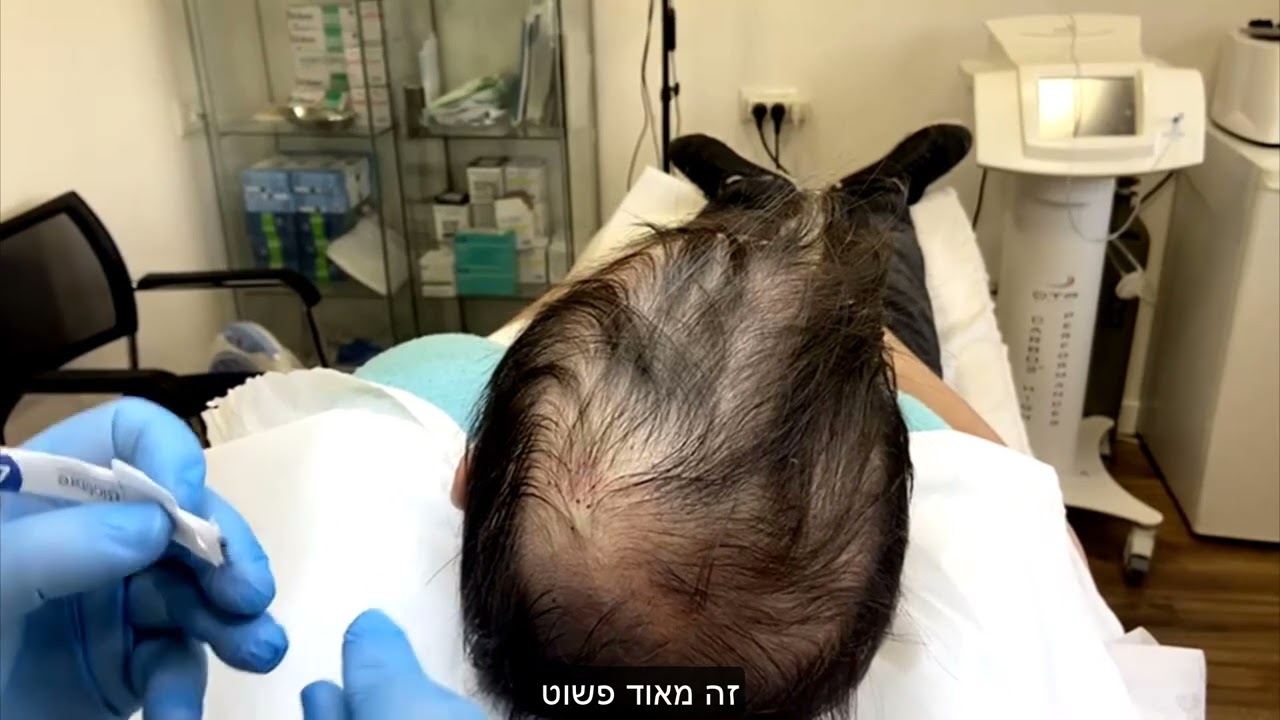 השתלת שיער סינתטי - הדגמת טיפול: השתלת 1,000 שיערות | ד