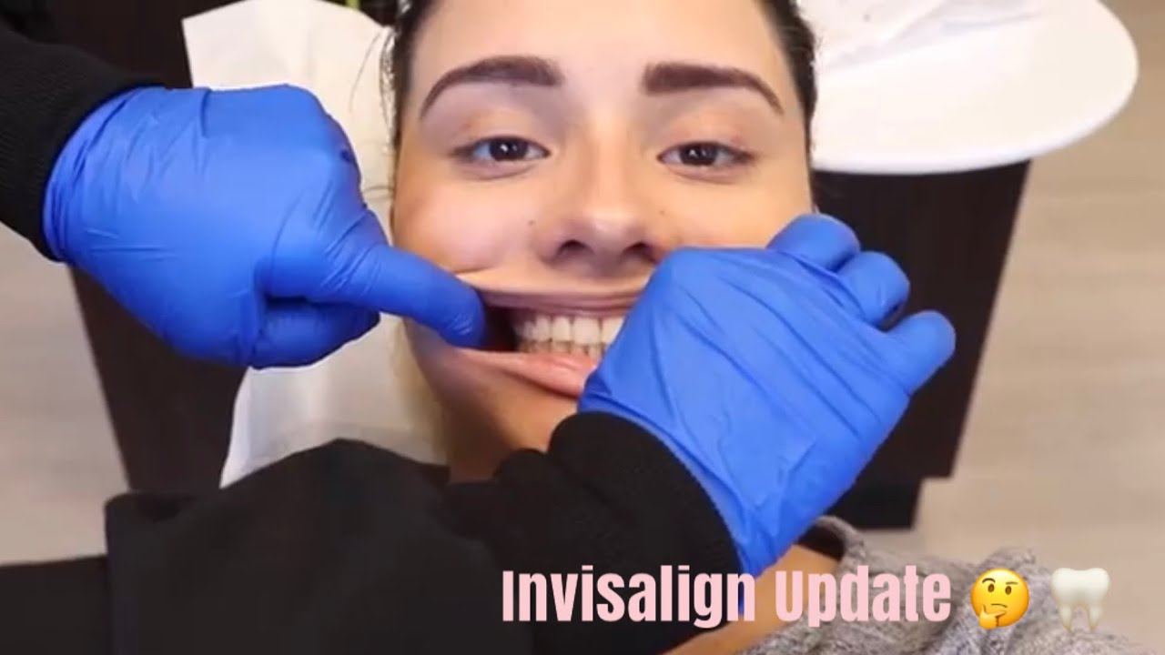 Invisalign Update After Re-Scan & Extra Trays : Am I Finally Done?