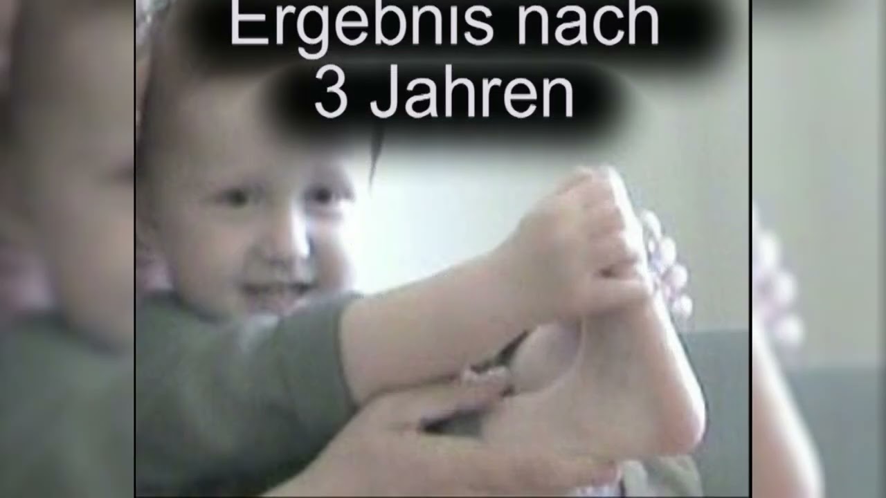 Ponseti | Teil 3 - Die Schienenbehandlung mit Endergebnis ©Semeda GmbH