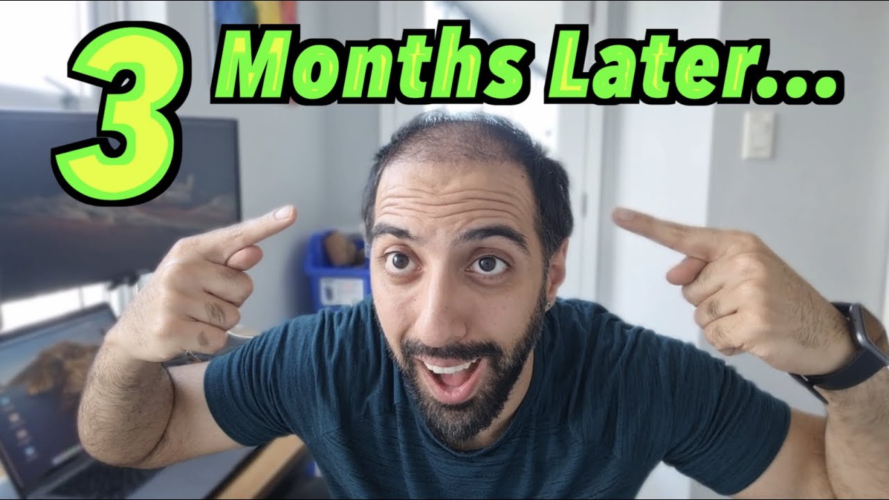3 month Hair Transplant Update from Turkey! / 6100 Grafts FUE