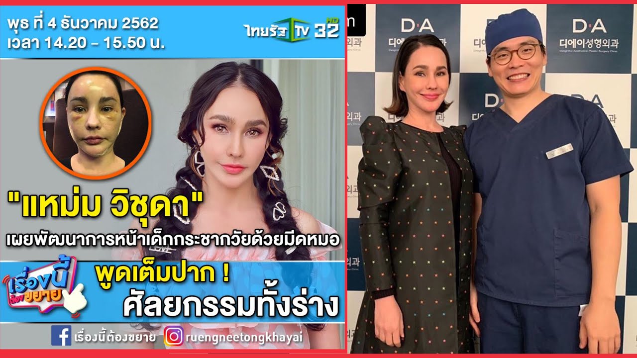 คุณแหม่ม วิชุดา พินดั้ม - ประสบการณ์ศัลยกรรมเกาหลี