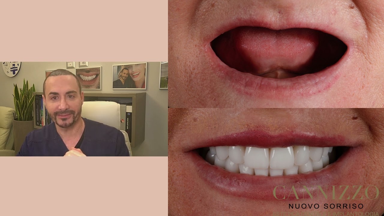 Cosa sono gli impianti pterigoidei e come si effettuano - Studio Dentistico Cannizzo