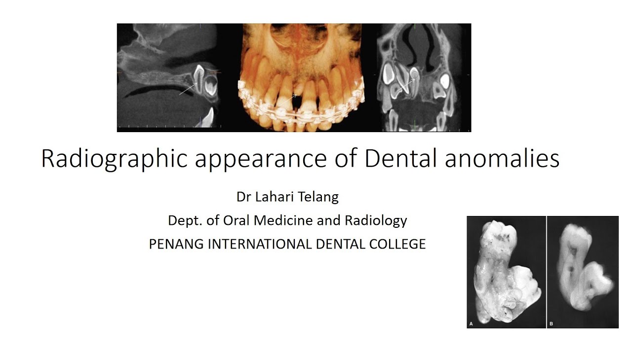 Radiographic appearance of Dental anomalies