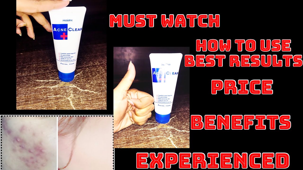 Acne clear plus face wash(Mistine)!!Must watch with my acne experience pics👍!!!