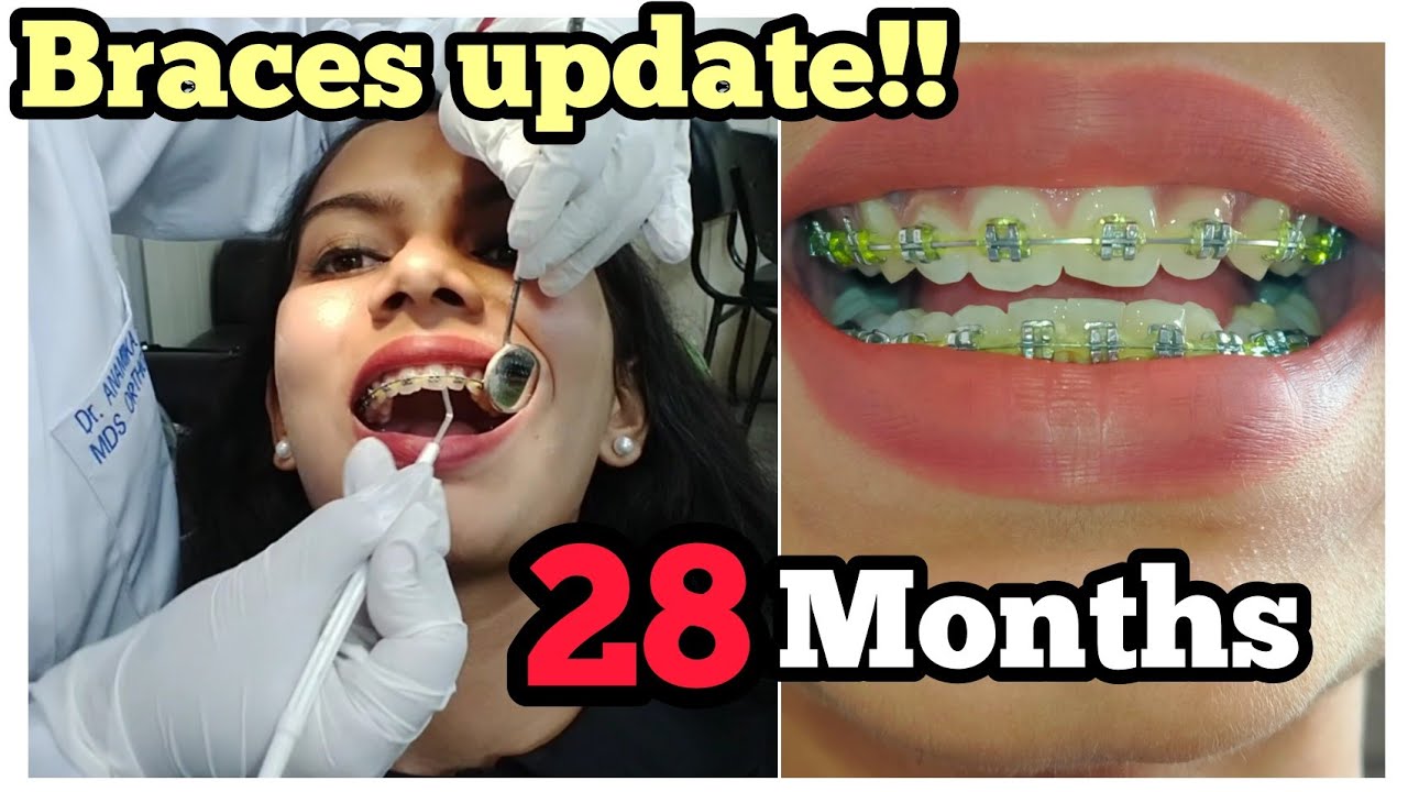 28-months with Braces/tightening vlog/braces update #teeth #braces#howto#dentist#orthodontist