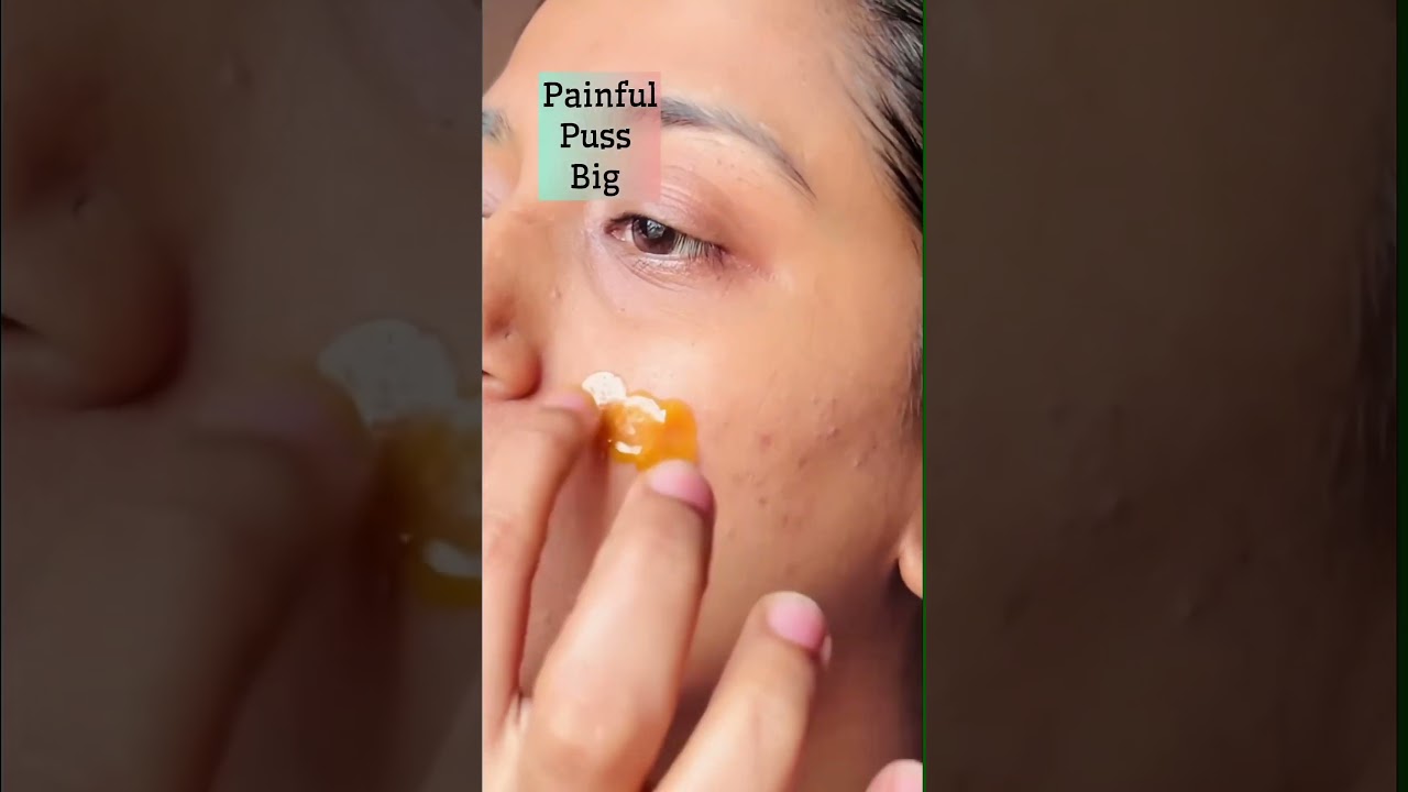 Bar-Bar Pimples Aa Rahe Hain? Ye 3 Cheezein Try Karo🔥 