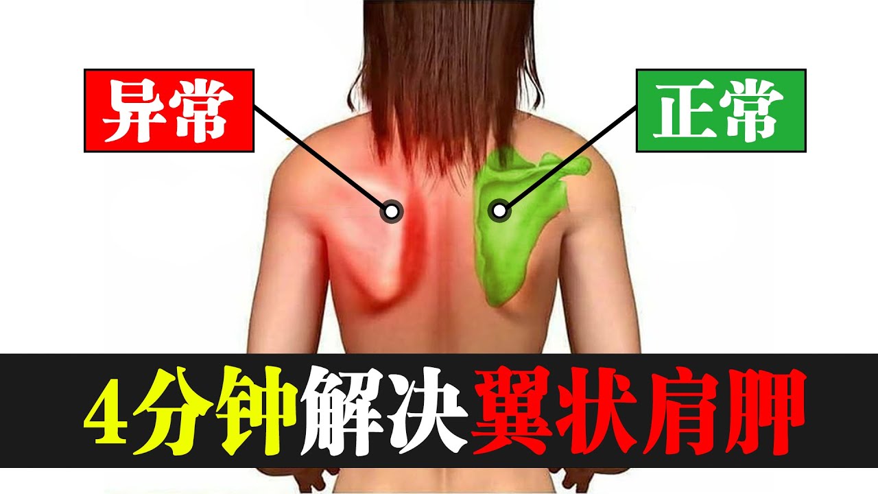 翼状肩胛怎么办？4分钟教你翼状肩胛恢复