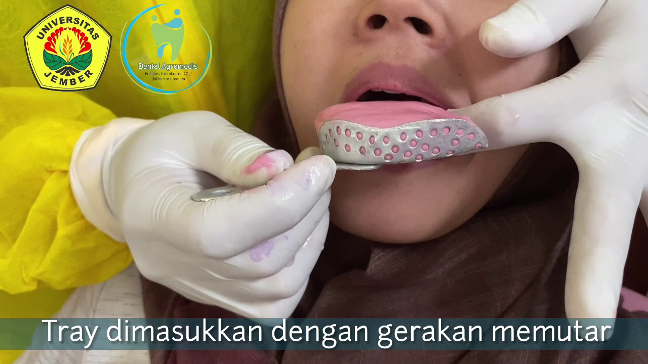 Irreversible hydrocolloid impression_VIDEO PEMBELAJARAN FKG UNEJ
