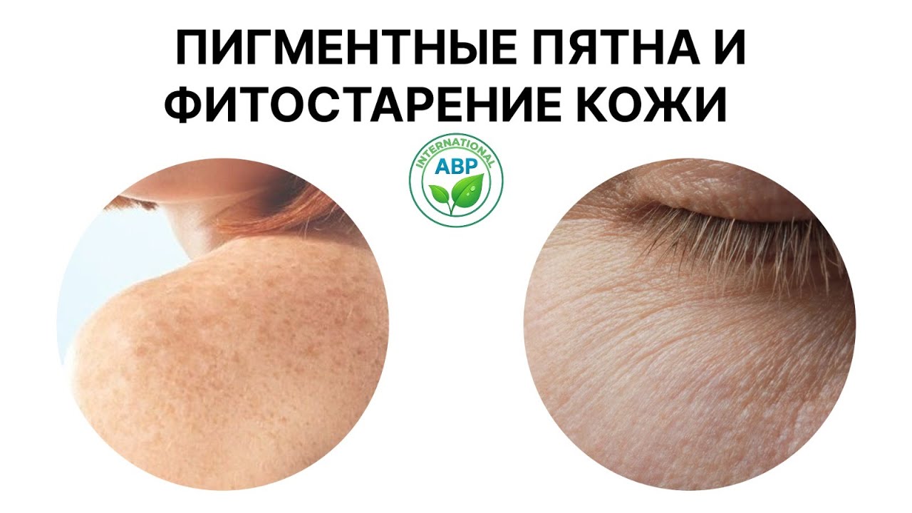 ПИГМЕНТНЫЕ ПЯТНА И ФИТОСТАРЕНИЕ КОЖИ
