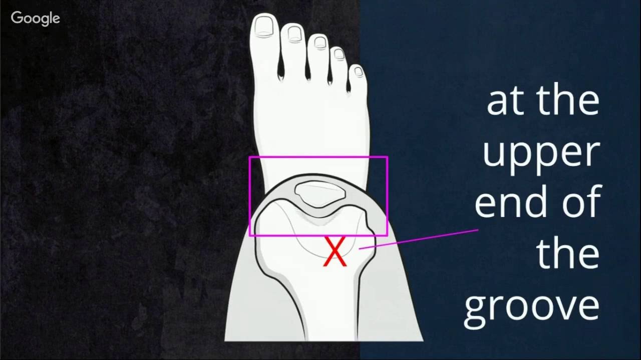 Putting trochlear dysplasia into context