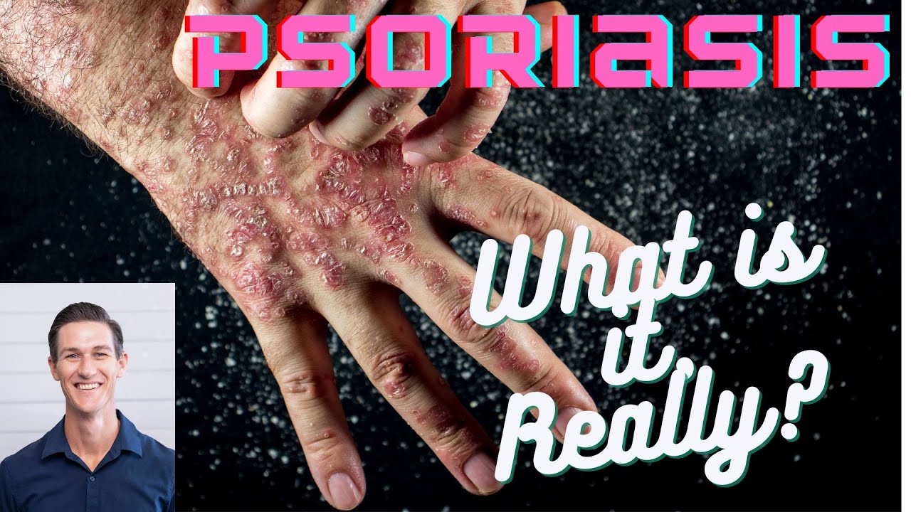 What is Psoriasis, Really?