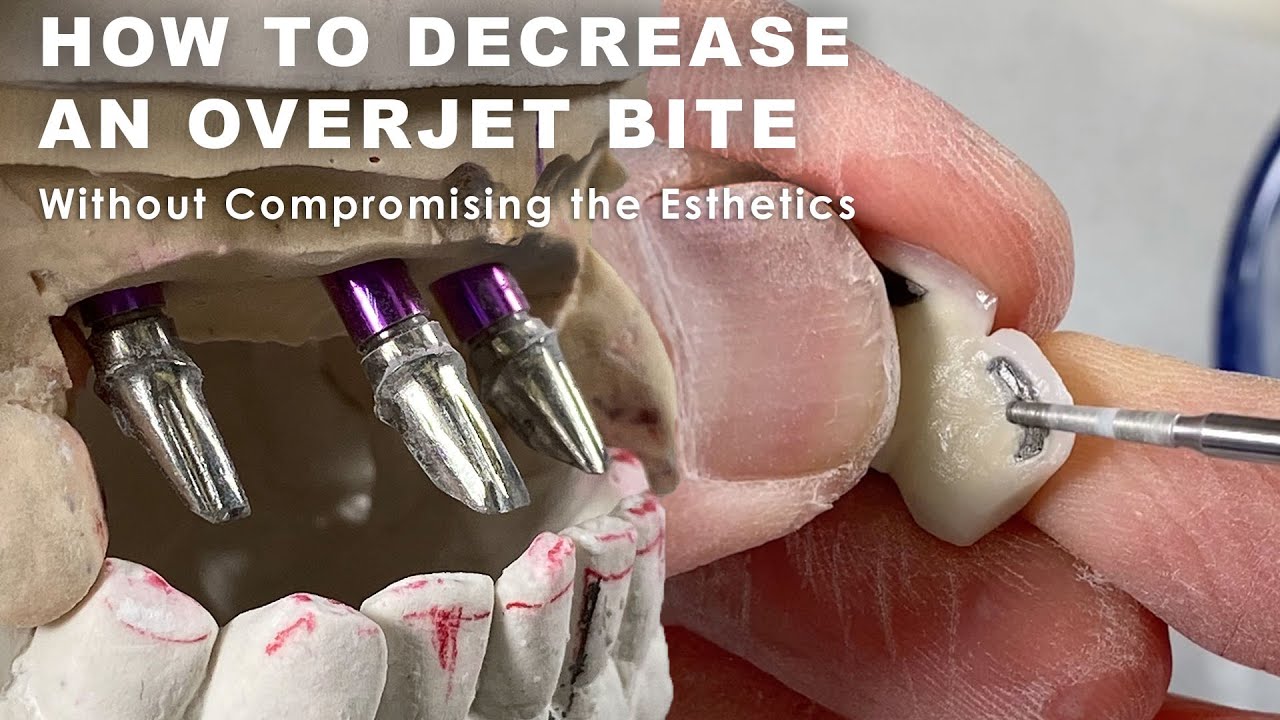 How to Decrease an Overjet Bite without Compromising the Esthetics
