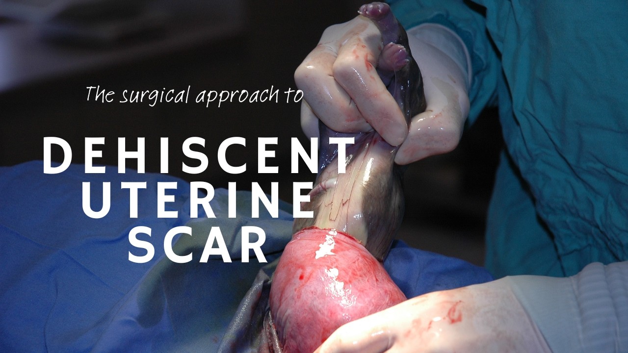 Surgical approach for the dehiscent uterine scar