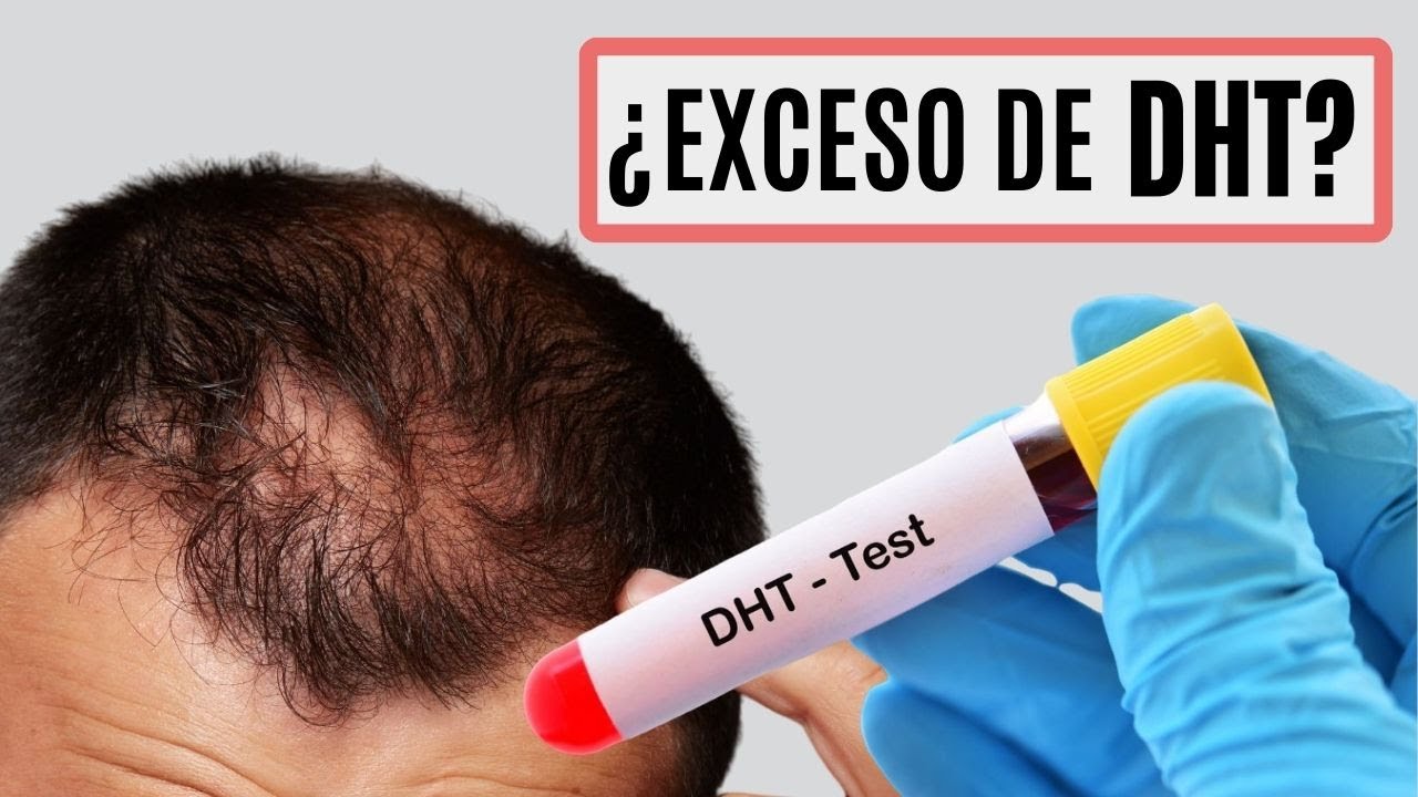 ALOPECIA causada por DHT 👉 Dihidrotestosterona y la CALVICIE