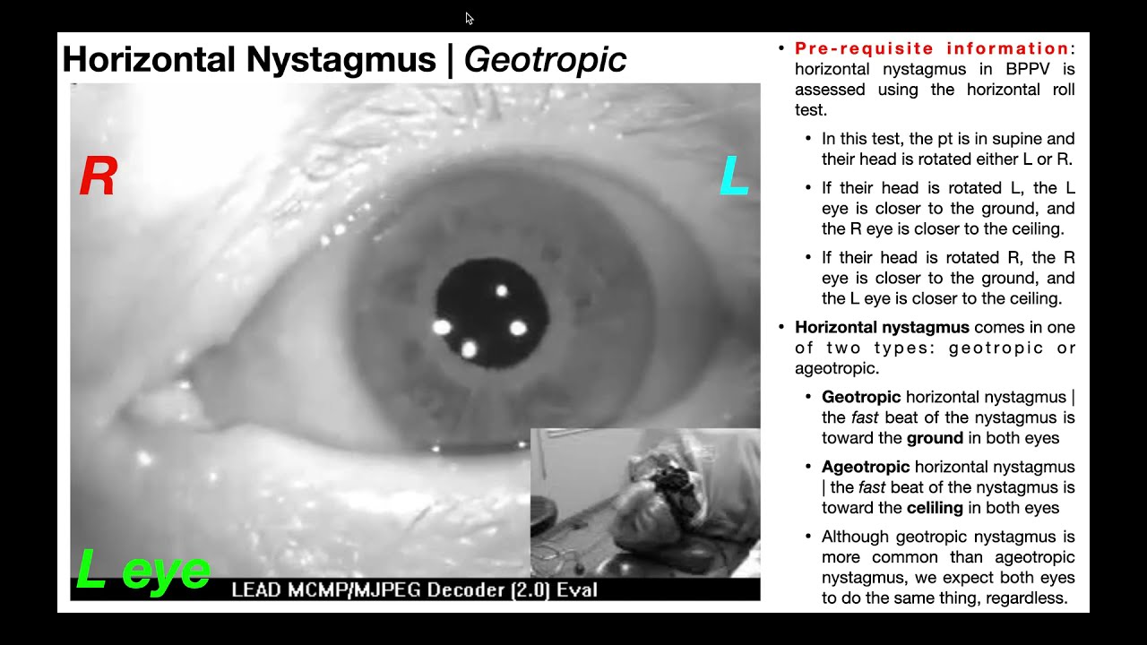 Nystagmus EXPLAINED 👀 | Visualizing & Interpretation